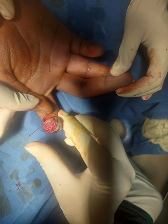 hand surgery (flap) in Mandi HP